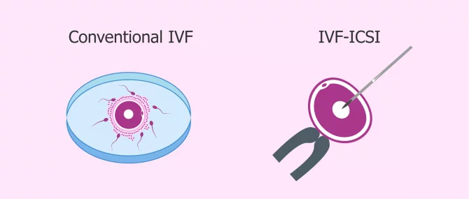 格鲁吉亚单身代孕 types of in vitro fertilization available today